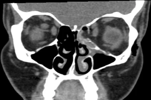 Gãy vụn xương hốc mắt vì hỉ mũi quá mạnh