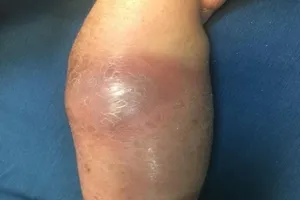 Bé 5 tuổi hoại tử xương do đắp lá chữa gãy tay