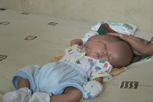 Bé trai sơ sinh có hai mặt, hai bộ não