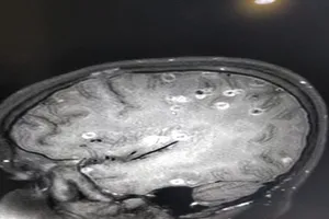 Kinh hoàng: Não bé 8 tuổi có 100 trứng sán dây