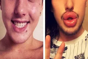 Môi suýt ‘nổ tung’ vì đi bơm cho giống thần tượng