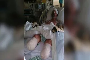 Cắt bỏ tứ chi vì nhiễm khuẩn từ nước bọt chó cưng