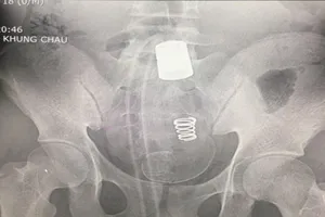 Lấy vòi xịt vệ sinh dài 45 cm từ hậu môn nam thanh niên