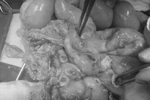 'Sốc nặng': Ruột bé trai thủng 50 lỗ vì nhiễm ấu trùng giun