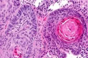 Hy hữu: ‘Rụng’ dương vật do ung thư mà không biết