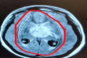 Khối u não hiếm hình thành từ… tế bào tinh trùng