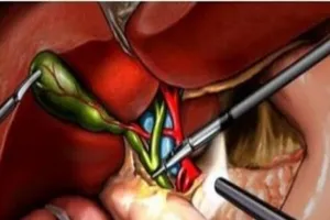 Cắt bỏ túi mật có ảnh hưởng đến tiêu hóa?