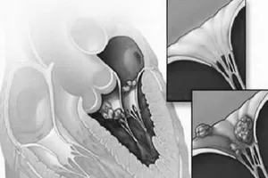 Nhận biết và phòng ngừa bệnh thấp tim