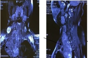 Phẫu thuật lấy bướu giáp 'khủng' trốn trong lồng ngực 10 năm