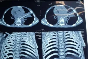 Bị que xiên thịt nướng đâm xuyên phổi, vỡ đốt sống