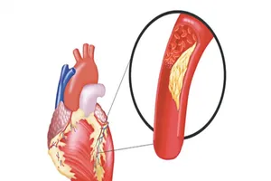 Ai dễ mắc máu nhiễm mỡ?