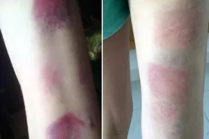 Tạm đình chỉ cô giáo bị tố đánh 22 học sinh bầm tím