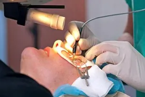 Có nên phẫu thuật chữa cận thị?