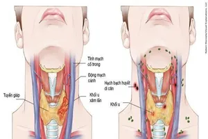 Ung thư vòm họng (Hình minh họa)
