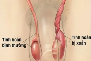 Tinh hoàn bình thường và tinh hoàn bị xoắn. (Ảnh minh họa)