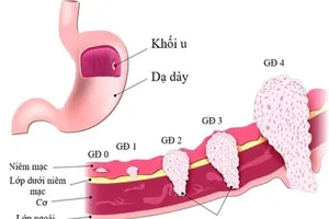 Các loại ung thư khó phát hiện sớm