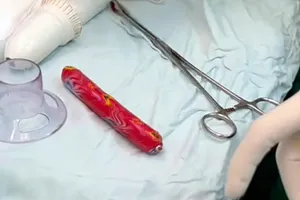 Thử 'cảm giác lạ', nam thanh niên bị kẹt cây xúc xích trong hậu môn