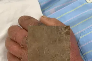 Suy đa tạng, hoại tử tay vì tự chữa rắn cắn theo kinh nghiệm dân gian 