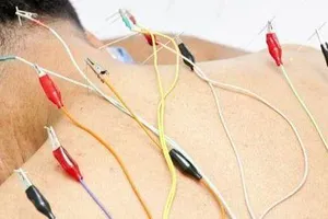 Điều trị đau đầu hậu COVID-19 bằng điện châm