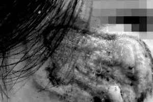 Bôi thuốc chứa axit trị nám, nhiều người bị nhiễm trùng, sẹo xấu