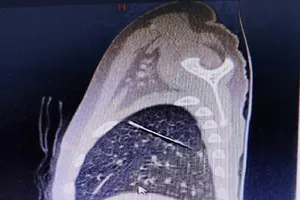 Kim may quần áo nằm sâu trong phổi bé trai 4 tuổi