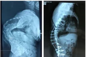 Cắt xương sườn giúp người đàn ông ‘siêu gù’ đứng thẳng 