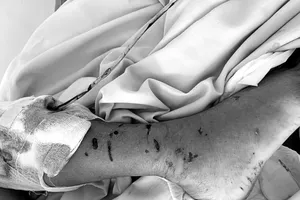 Đang cắt rau, bị chó nhà nuôi tấn công phải vào viện cấp cứu