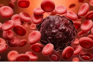 Ung thư máu (Ảnh: Internet)