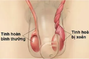 Bé trai phải cắt bỏ tinh hoàn sau cơn đau 5 ngày nhưng cố nhịn