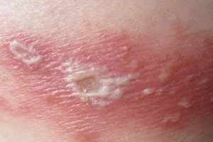 Biểu hiện trên da của bệnh zona thần kinh. Ảnh: Bệnh viện Bệnh Nhiệt đới Trung ương