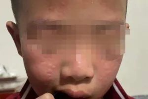 Nhiều học sinh dị ứng, sưng mắt sau khi trường phun thuốc diệt muỗi