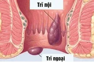 Bỗng dưng đi cầu ra máu có phải bị bệnh trĩ?