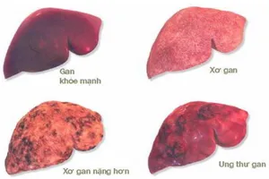 Khi nào nên tầm soát ung thư gan?