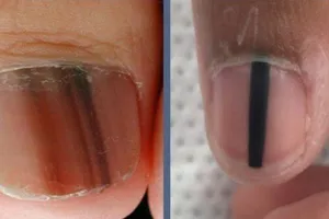 Sọc đen trên móng tay có phải dấu hiệu ung thư?