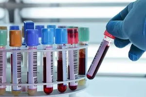 Xét nghiệm máu có nhất thiết phải nhịn ăn?