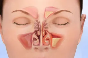 Xông lá trị dứt được bệnh viêm xoang không?