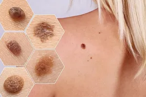 Quy tắc ABCDE nhận biết nốt ruồi có nguy cơ ung thư