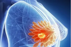 Khi nào nên mổ u xơ tuyến vú?