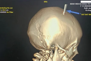 Hi hữu: Bé gái bị kéo đâm thủng hộp sọ