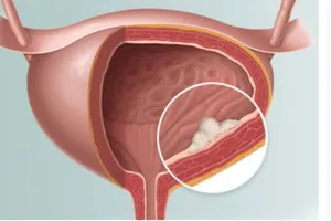 Ung thư bàng quang di truyền không?