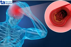 Xuất huyết não có thể hồi phục được không?