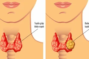 Bác sĩ ơi, cắt tuyến giáp có còn nói được nữa không?