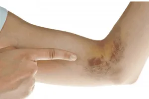 Giảm tiểu cầu có phải bị ung thư máu?