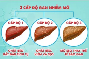 Gan nhiễm mỡ có mấy cấp độ, độ 2 đã nặng chưa?