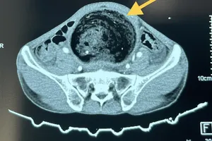 Khối phân tích tụ lâu năm khiến người đàn ông phải cắt đại tràng