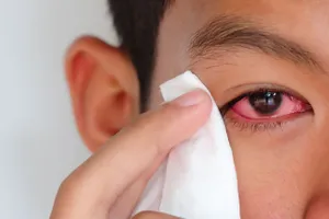 Có nên dùng lá trầu không chữa đau mắt đỏ?