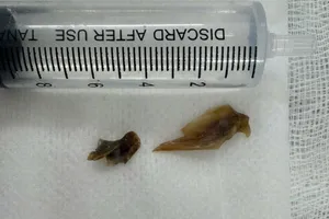 Mảnh xương vịt mắc trong phổi suốt 2 năm