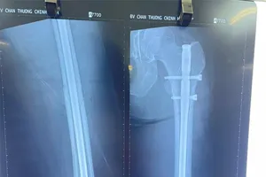 1 người mẫu chấn thương gãy chân khi đang chơi pickleball