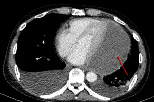 14 ngày giành sự sống cho người bệnh tràn mủ màng ngoài tim hiếm gặp 