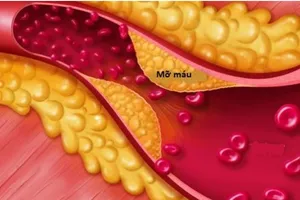 Nguyên nhân khiến người gầy vẫn bị bệnh mỡ máu